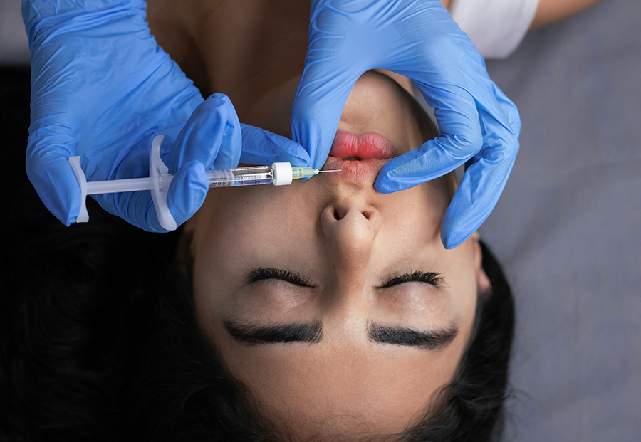 Lip Filler