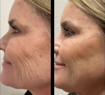 Anti-Aging Treatments