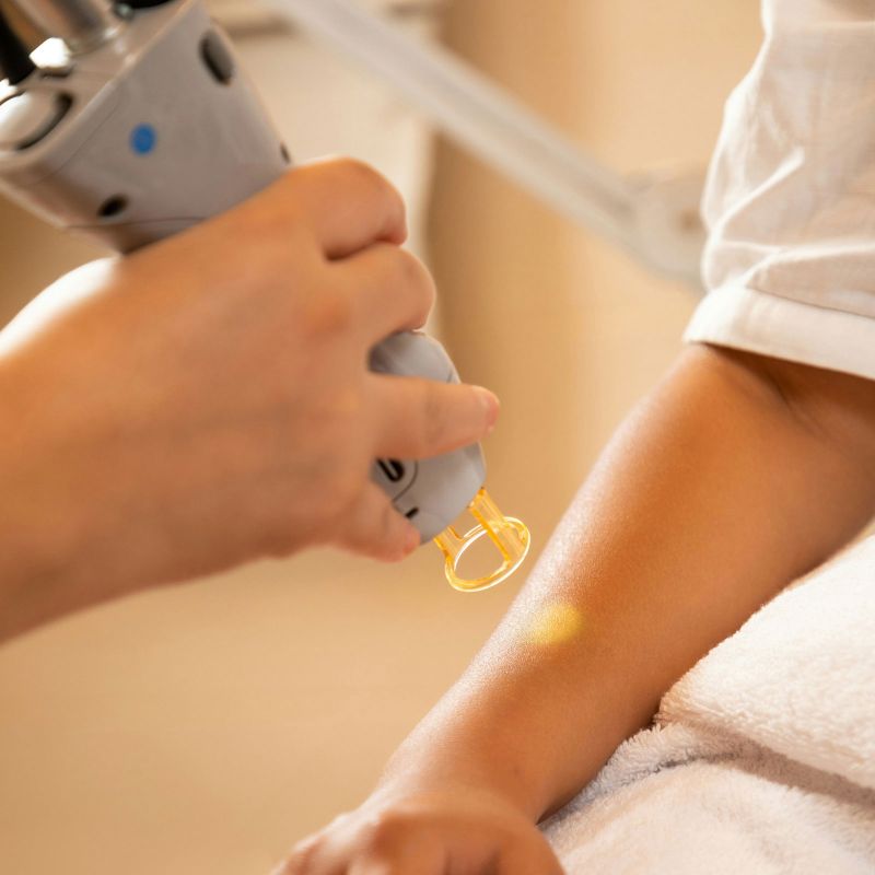 Laser hair removal treatment in clinical setting