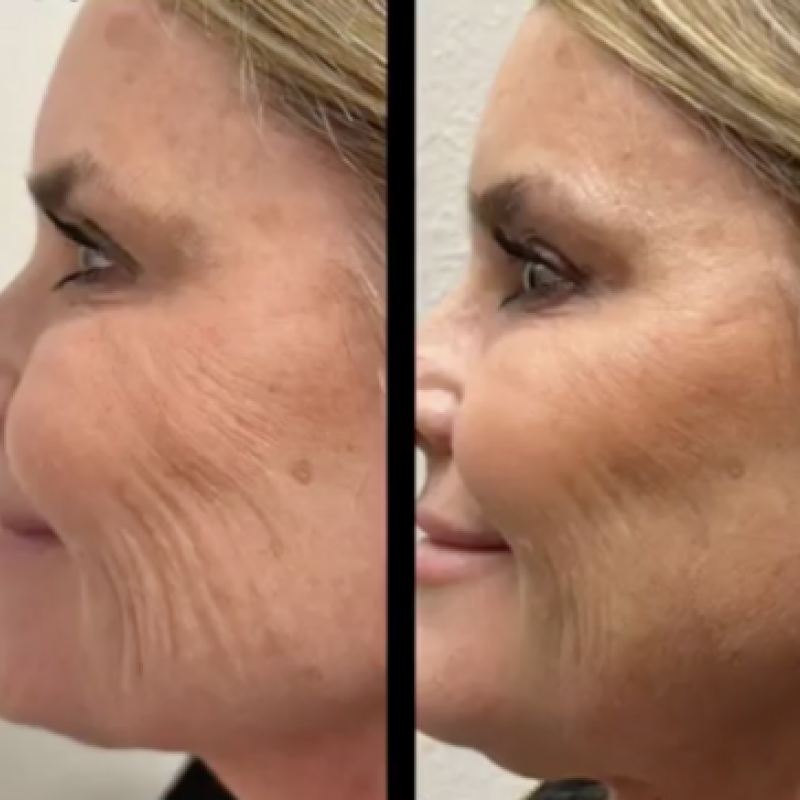 Hyper dilute Radiesse before and after wrinkle reduction
