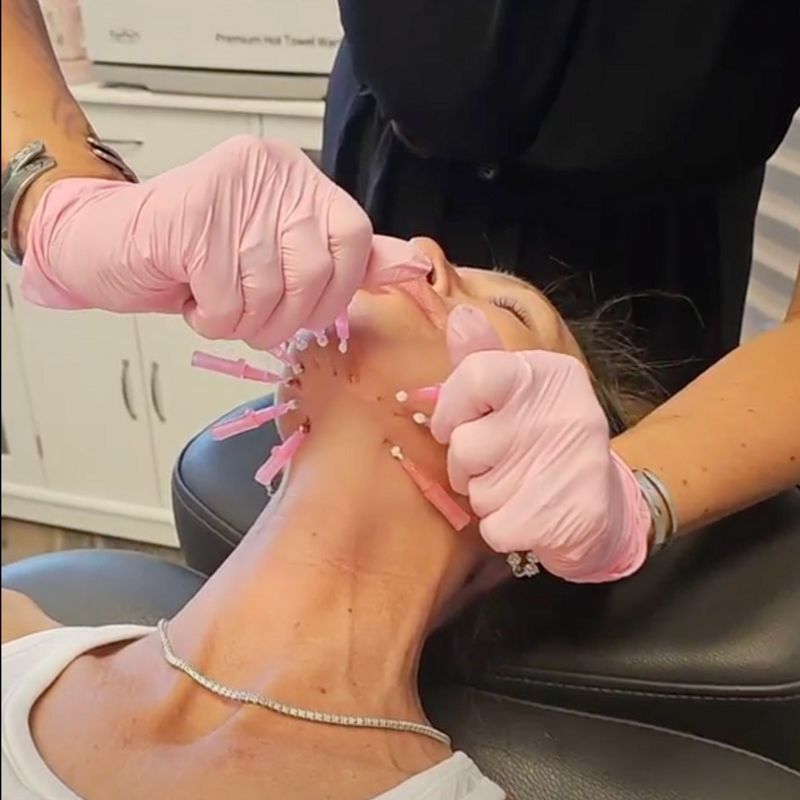 Professional microneedling treatment on woman’s face