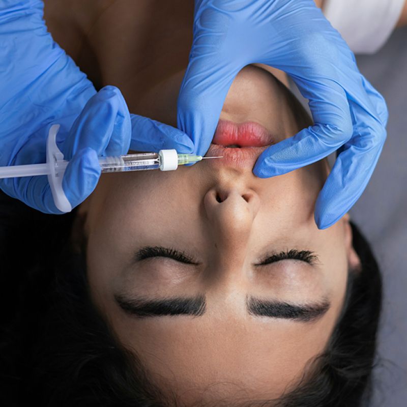 Lip Filler