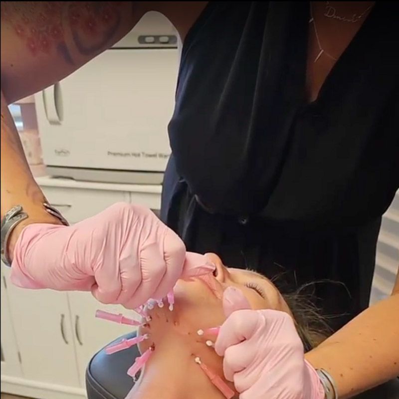 Professional microneedling treatment on woman’s face